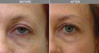 Chicago Laser Skin Tightening